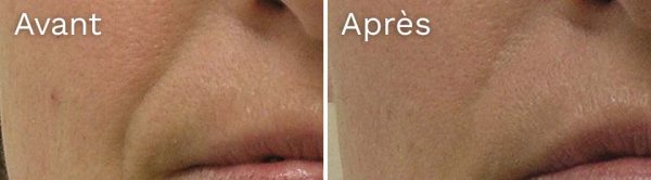pli-nasal-avant-apres hydrafacial - résultat avant-après - pli nasal