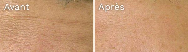 ridules-avant-apres hydrafacial - résultat avant-après -ridules