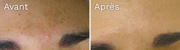 tachesbrunes-avant-apres hydrafacial - résultat avant-après - taches brunes