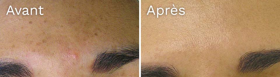 hydrafacial - résultat avant-après - taches brunes