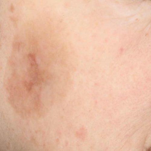 tache brune après tache brune après