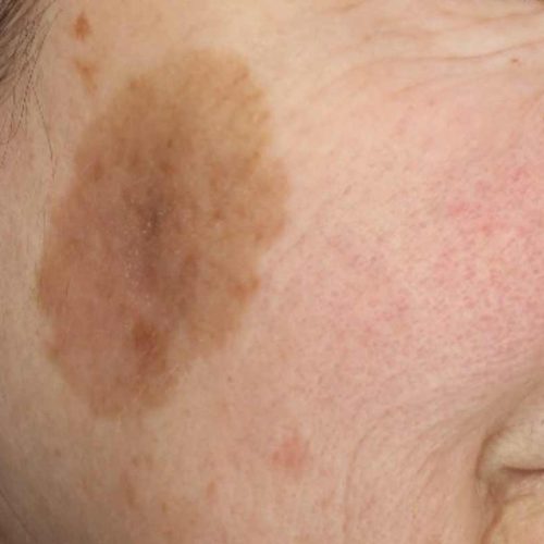 tache brune avant tache brune avant