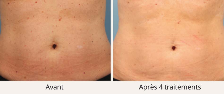 taches pigmentaires - avant-après