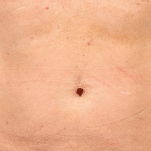 taches pigmentaires après taches pigmentaires après