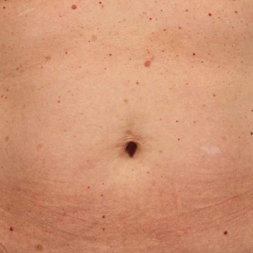 taches pigmentaires avant taches pigmentaires avant