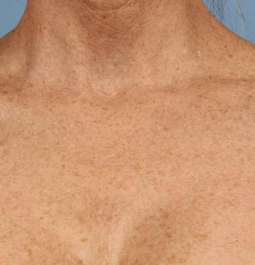 taches pigmentaires avant taches pigmentaires avant