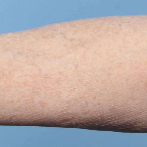 taches de vieillesse après taches de vieillesse après