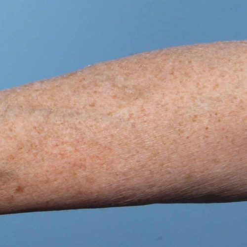 taches de vieillesse avant taches de vieillesse avant