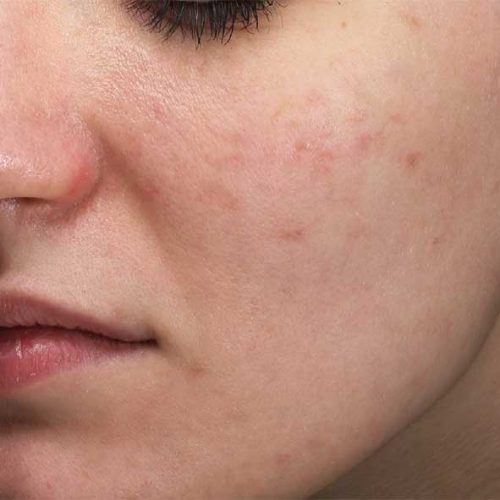 traitement de l’acné au laser après traitement de l’acné au laser après